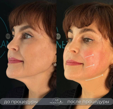 фото Сделайте свою кожу молодее и ровнее с радиесс-моделированием!